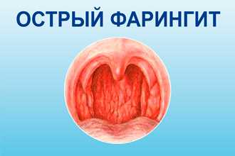 Фарингит