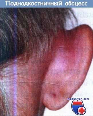 Поднадкостничный абсцесс при мастоидите и среднем отите