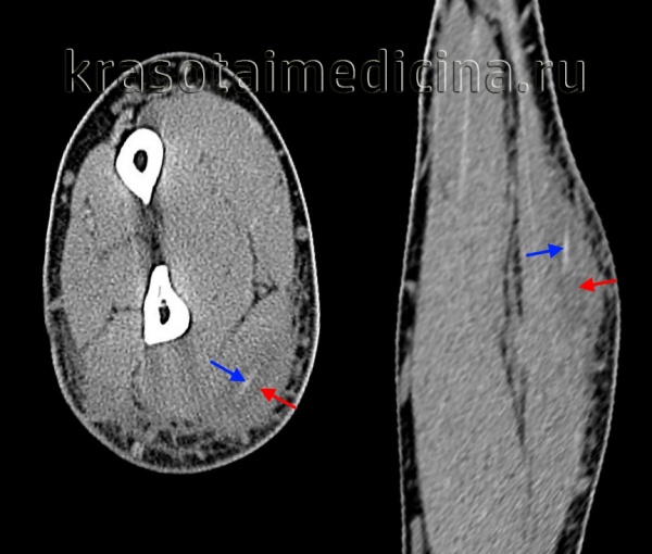 Субпериостальный абсцесс орбиты