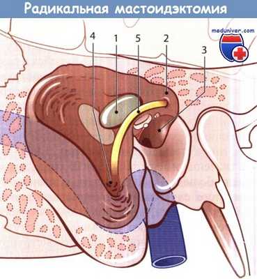 Радикальная мастоидэктомия
