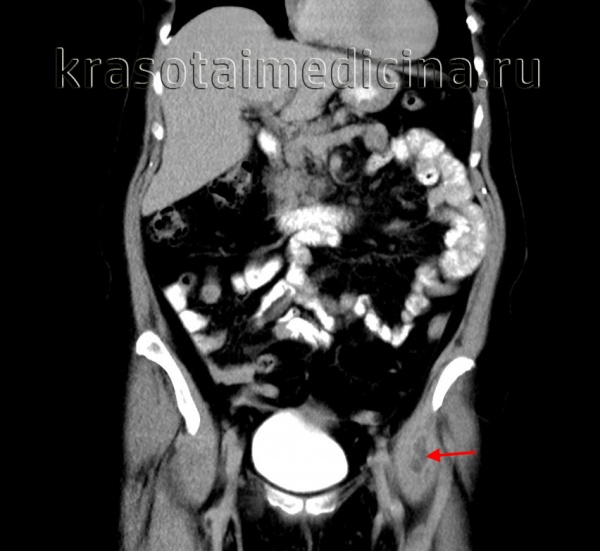 Субпериостальный абсцесс орбиты