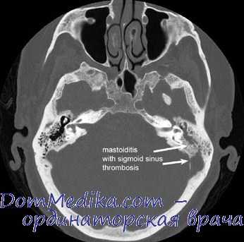 КТ при мастоидите с тромбозом сигмовидного синуса
