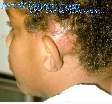 Мастоидит у ребенка