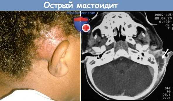 Острый мастоидит