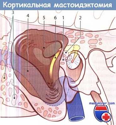 Операция при мастоидите - кортикальной мастоидэктомии
