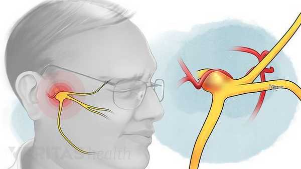 тройничный нерв на лице