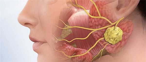 Невралгия тройничного нерва