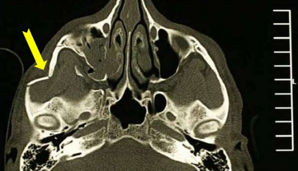 Компьютерная томография. Перелом скуловой дуги (желтая стрелка)
