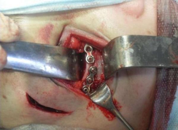 Остеосинтез скуловой кости