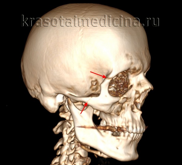 Перелом верхней челюсти