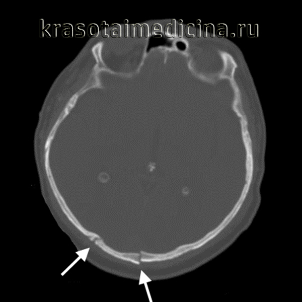 Перелом верхней челюсти