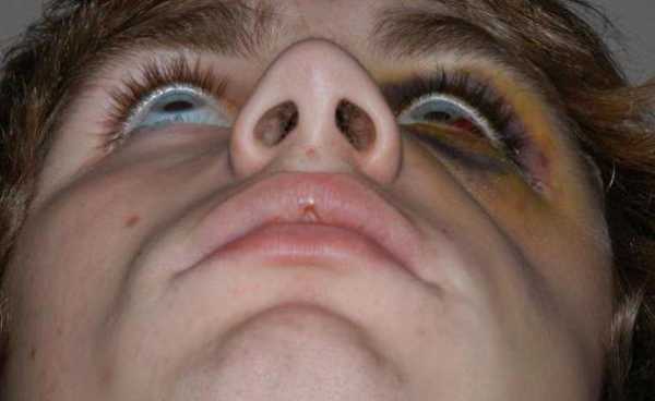 Перелом черепа