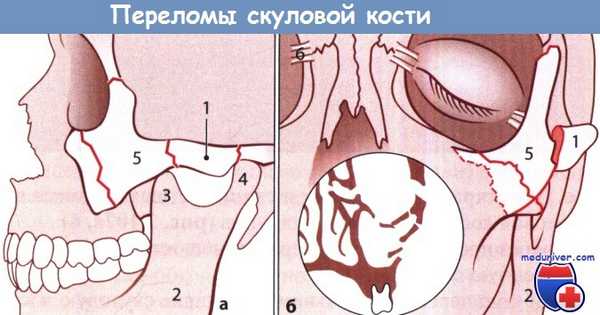Классификация переломов скуловой кости