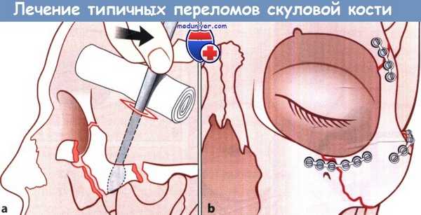 Лечение типичных переломов скуловой кости