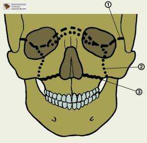 Перелом костей лица