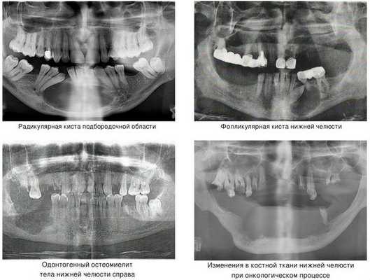 Причины патологического перелома нижней челюсти