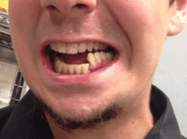 Открытый перелом челюсти со смещением