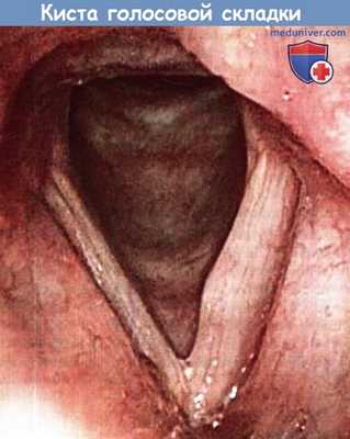 Киста голосовой складки