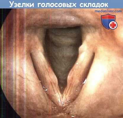 Узелки голосовых складок