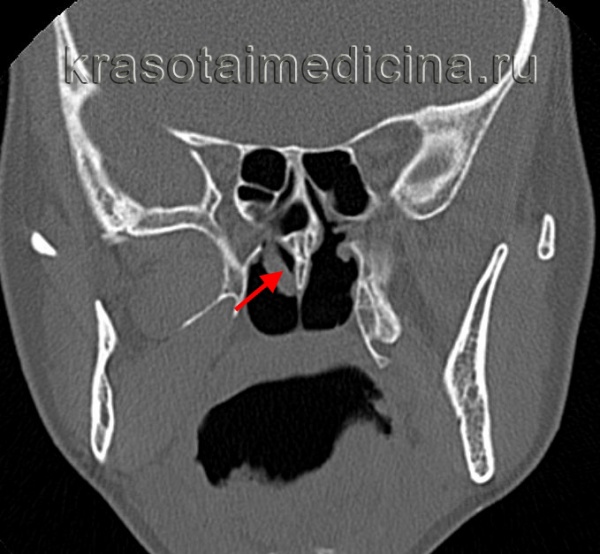 Полипы носа