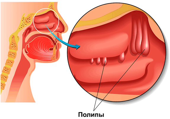 nasal_polyps1.png