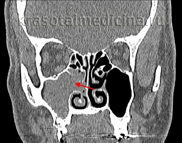 КТ придаточных пазух носа. Полип правой в/челюстной пазухи, пролабирующий в средний носовой ход.