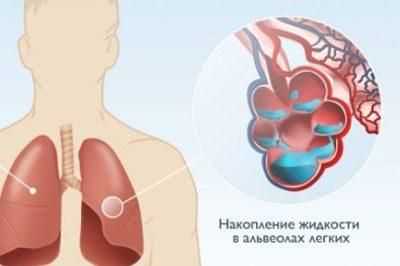 Отек легких