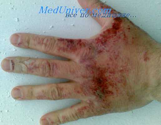 ожог ипритом