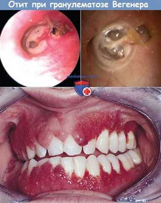 Отит при гранулематозе Вегенера