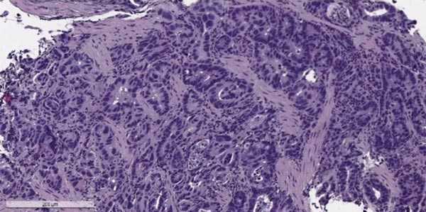 Карцинома желудка