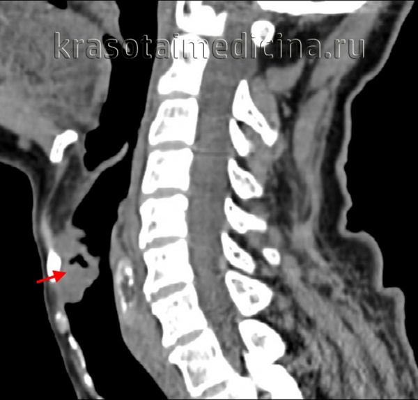Рак гортаноглотки
