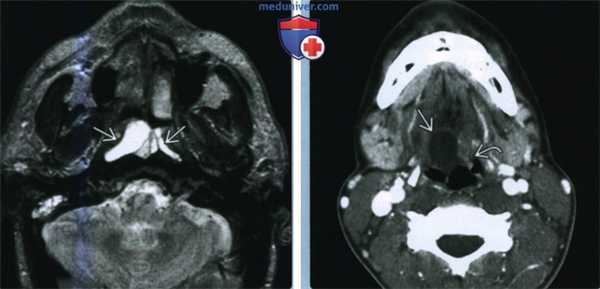 Ретенционная киста слизистого пространства глотки - лучевая диагностика