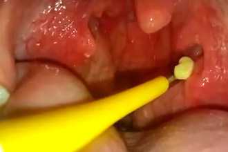 Удаление пробок в гландах