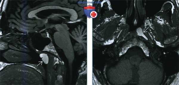 Ретенционная киста слизистого пространства глотки - лучевая диагностика