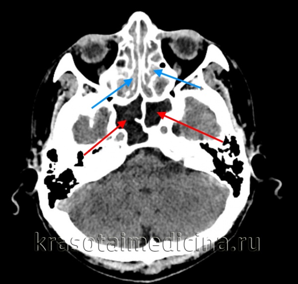 Поражение ЛОР-органов при ВИЧ-инфекции