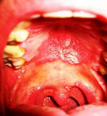 ПОРАЖЕНИЕ ЛОР ОРГАНОВ ПРИ ВИЧ ИНФЕКЦИИ.jpg