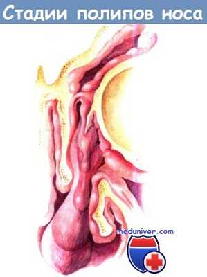 Стадии полипов носа