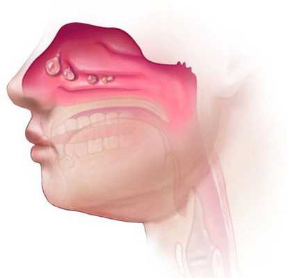 Полипы в носу
