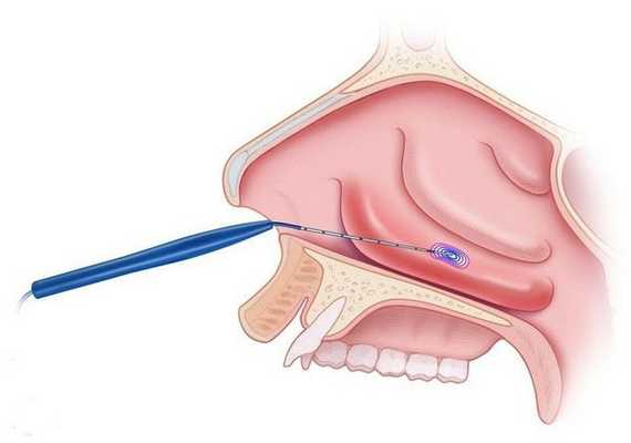 Коагуляция носовых раковин