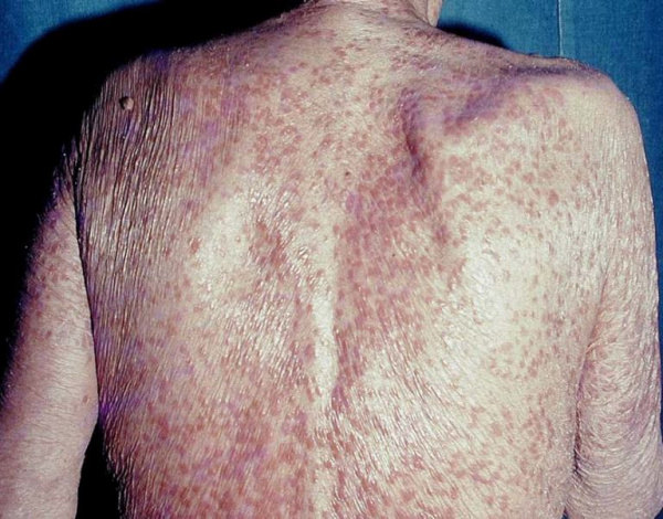 Саркоидоз кожи