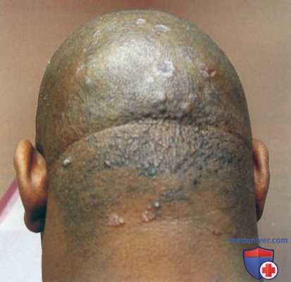 Саркоидоз кожи