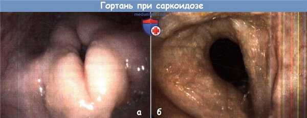 Гортань при саркоидозе
