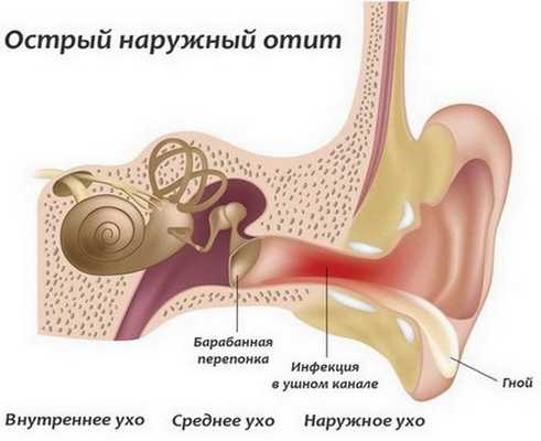 Наружный отит