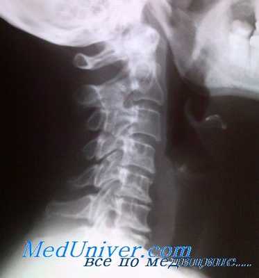Шейный остеохондроз