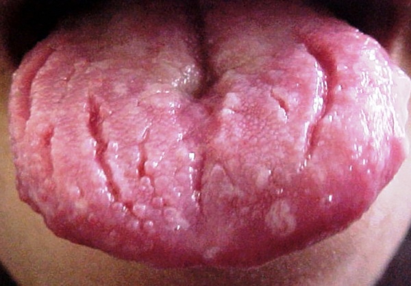 Складчатый язык при синдроме Мелькерссона-Розенталя