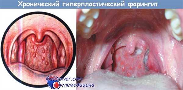Хронический гиперпластический фарингит