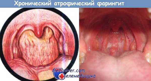 Хронический атрофический фарингит