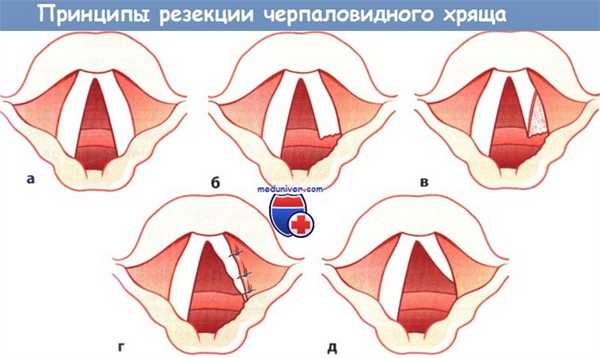 Принципы резекции черпаловидного хряща