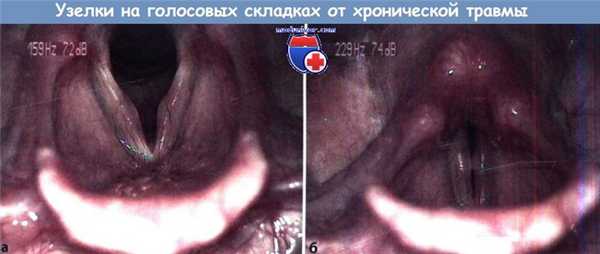 Узелки на голосовых складках от хронической травмы