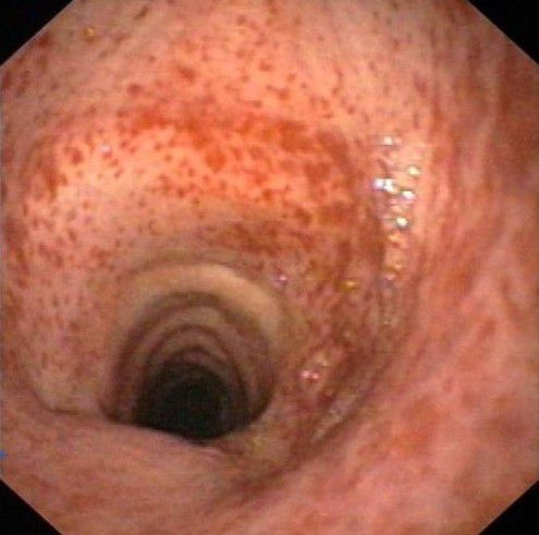 Петехии на трахее